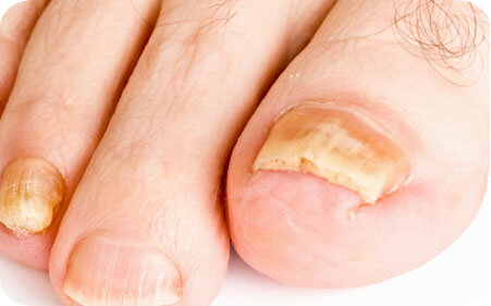 Soins des pieds pour problèmes d'ongles incarnés